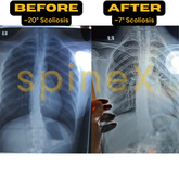Anti-Surgery Scoliosis Protocol: Unilateral Correction