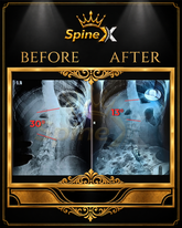 SpineX™ 3D Scoliosis Method | 4-Week Personalized Program