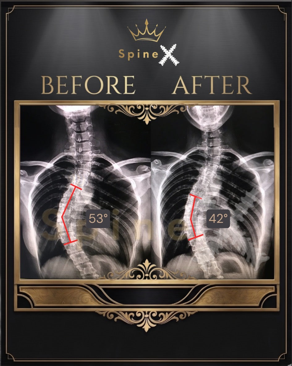 X-ray comparison of spine before and after treatment with 'SpineX' 53 degree to 42 degree natural correction
