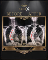 X-ray comparison of spine before and after treatment with 'SpineX' 53 degree to 42 degree natural correction