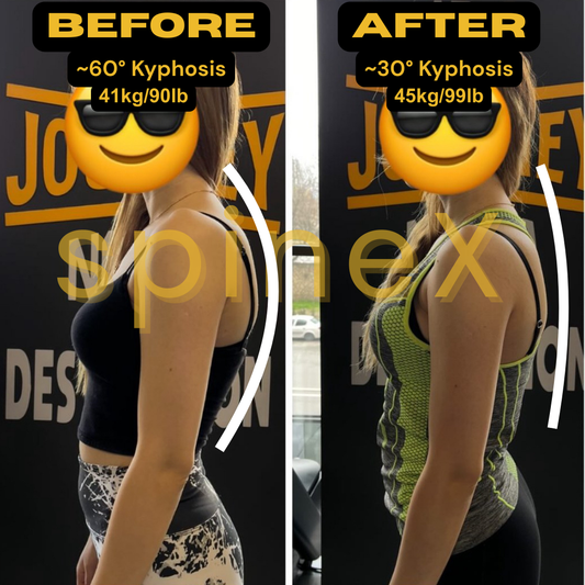 Hunchback Posture before after transformation