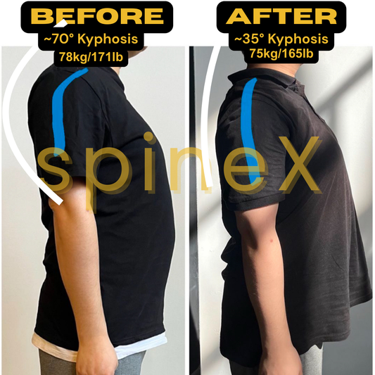 Kyphosis&Forward Neck before after by SpineX 