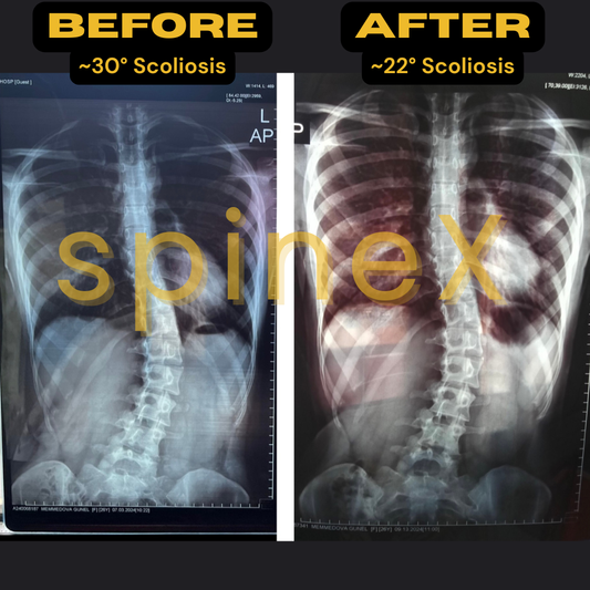 X-ray showing thoracolumbar scoliosis reduction from 30° to 22° in 8 weeks using the SpineX Method