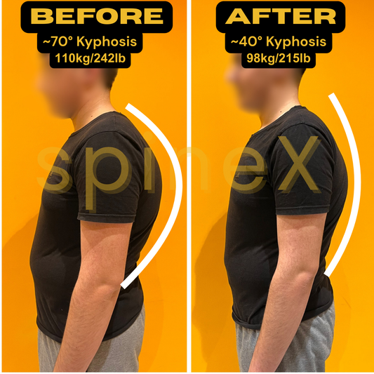 Before and after posture transformation from kyphosis correction using the SpineX Method