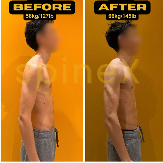 Before and after scoliosis correction showing improved posture and muscle symmetry through fitness training
