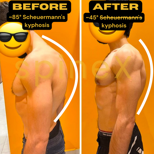 Before and after photo showing kyphosis correction through kyphosis SpineX training