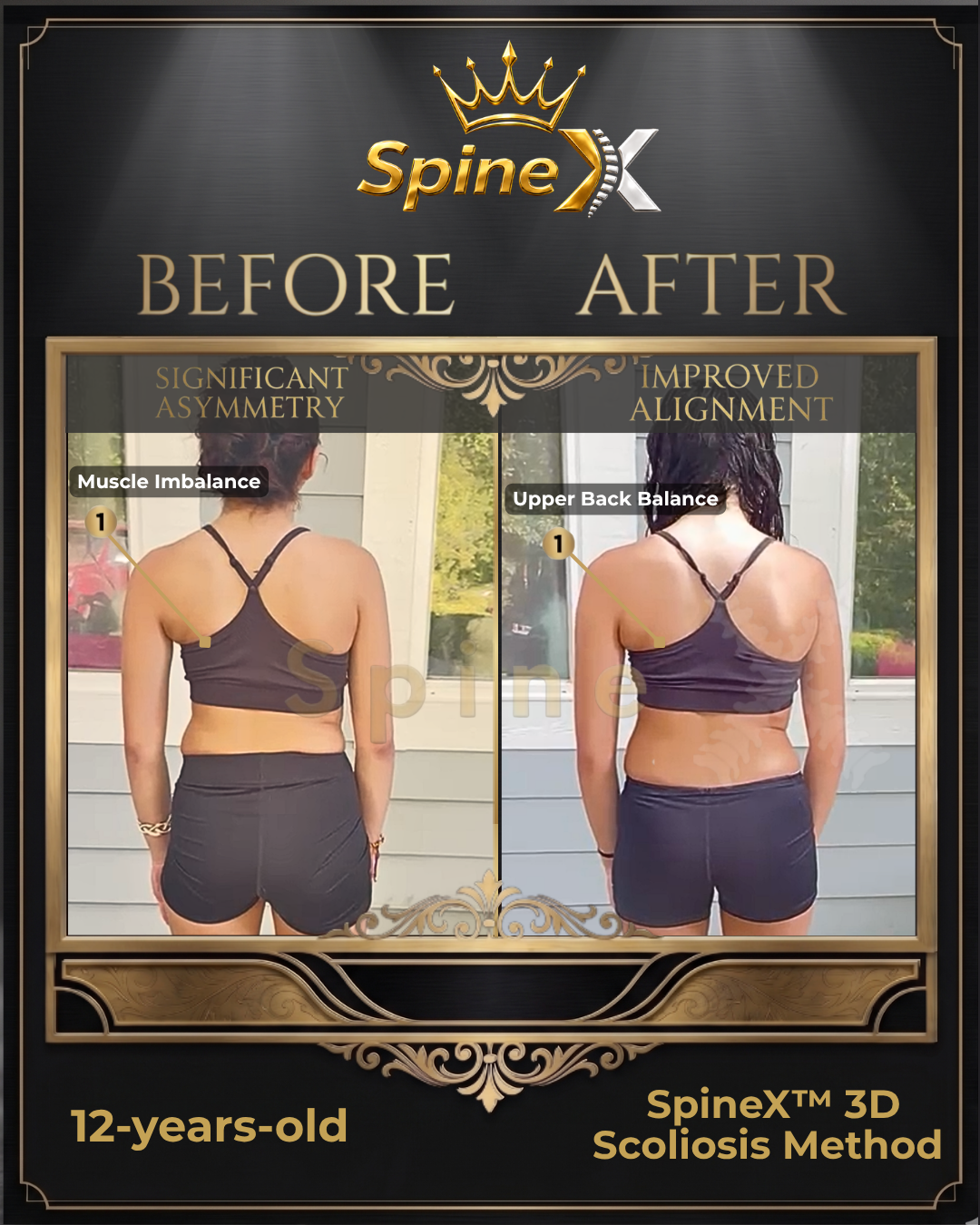 The "Watch and Wait" Trap: Why Passive Observation Costs Teenagers Their Spine Corrective Window