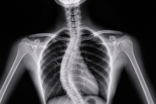 Standing full-spine X-ray showing adolescent idiopathic scoliosis with a visible thoracic and lumbar spinal curvature. Medical radiograph used to illustrate scoliosis assessment, Cobb angle evaluation, and spinal alignment in a child or teenager.
