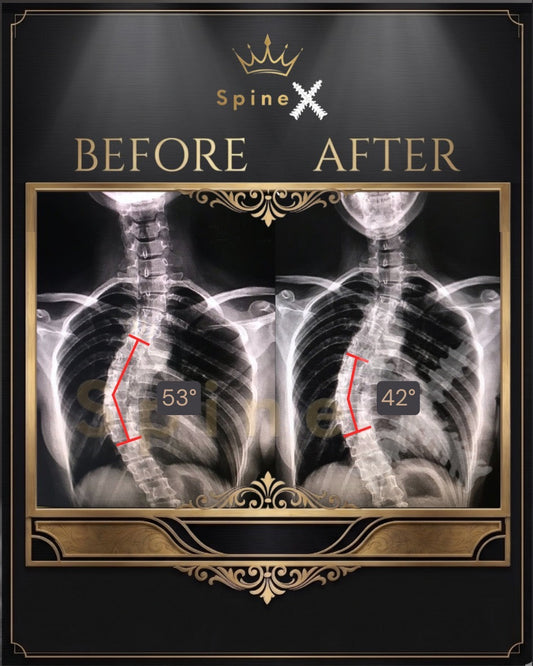 53 Degree Scoliosis Reduced to 42 Degrees: A Real Case Study