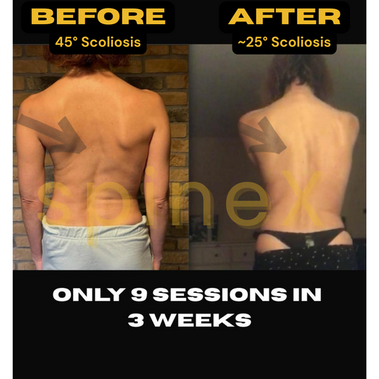 Before and after scoliosis photo showing 45° reduced to ~25° in 9 sessions over 3 weeks through fitness-based correction