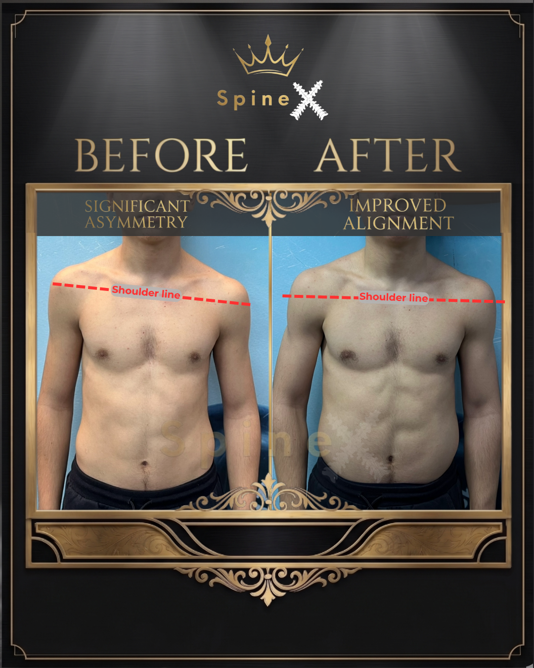 Online Scoliosis Transformation with 17-year old