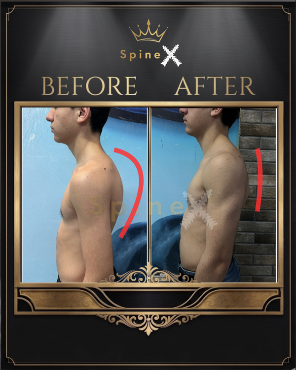 Online Kyphosis Transformation with same 17-year old transformation