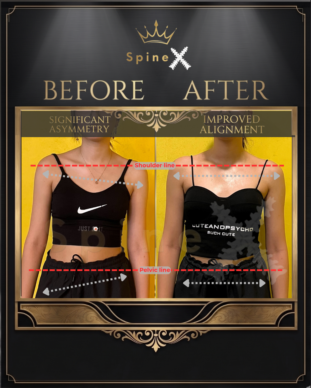Online Scoliosis Transformation with 17-year old
