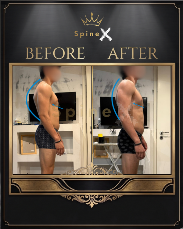 Online Kyphosis Transformation with same 18-year old transformation