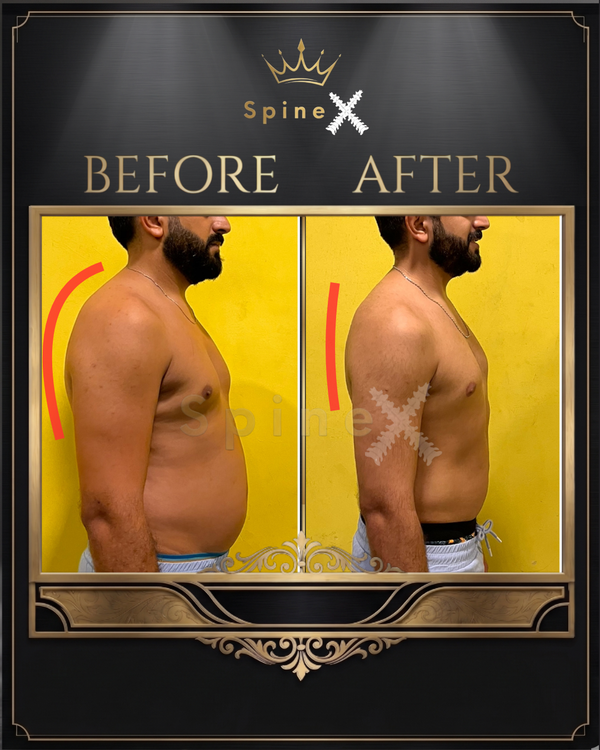 Online Kyphosis Transformation transformation