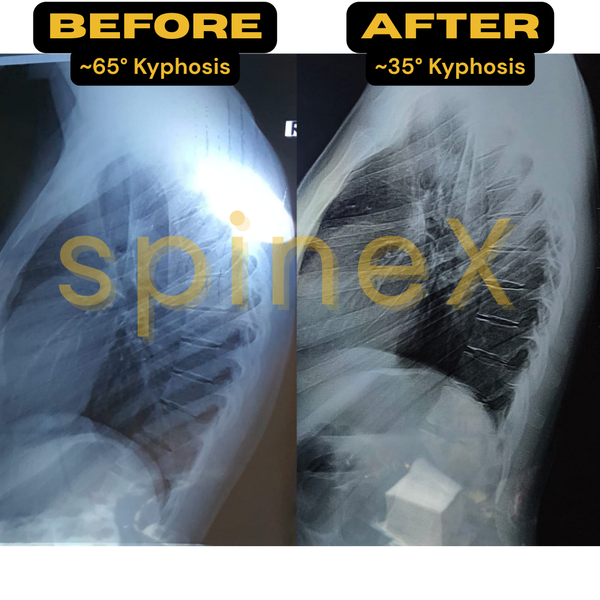 12-Session Kyphosis Fitness Plan + 4-Week Diet Plan (Fully Personalized)