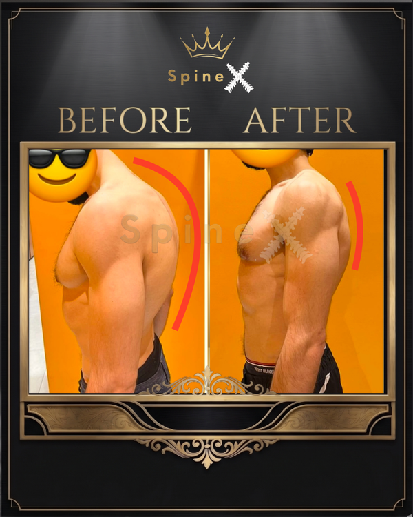 Online Kyphosis Transformation transformation