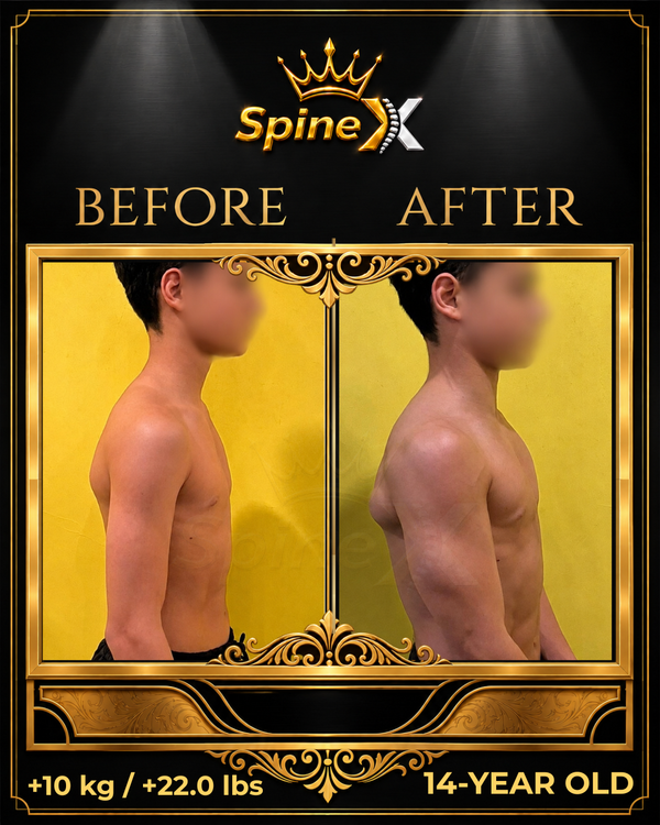 Online Scoliosis Transformation with 14-year old transformation