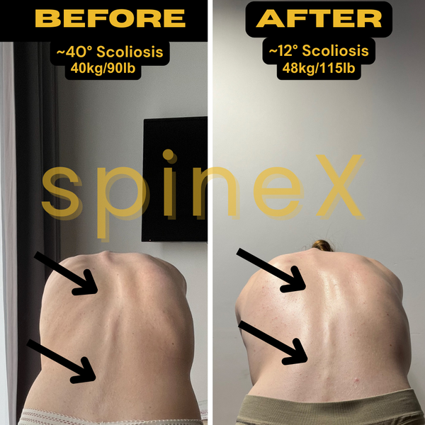 3-Session Scoliosis Correction Plan (Personalized & Spine-Safe)