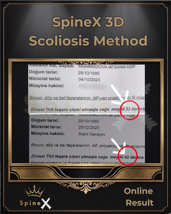 Radiology Proof of Previous 53° ⟶ 42° Cobb Angle Reduction transformation