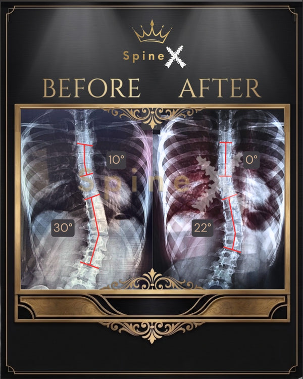Online Scoliosis Transformation X-ray Result transformation