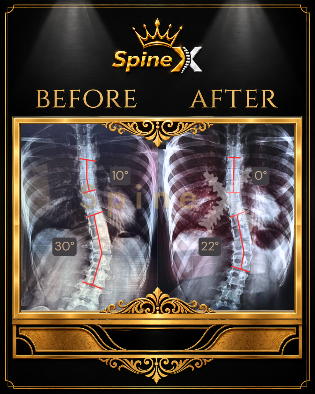 Online Scoliosis Transformation X-ray Result