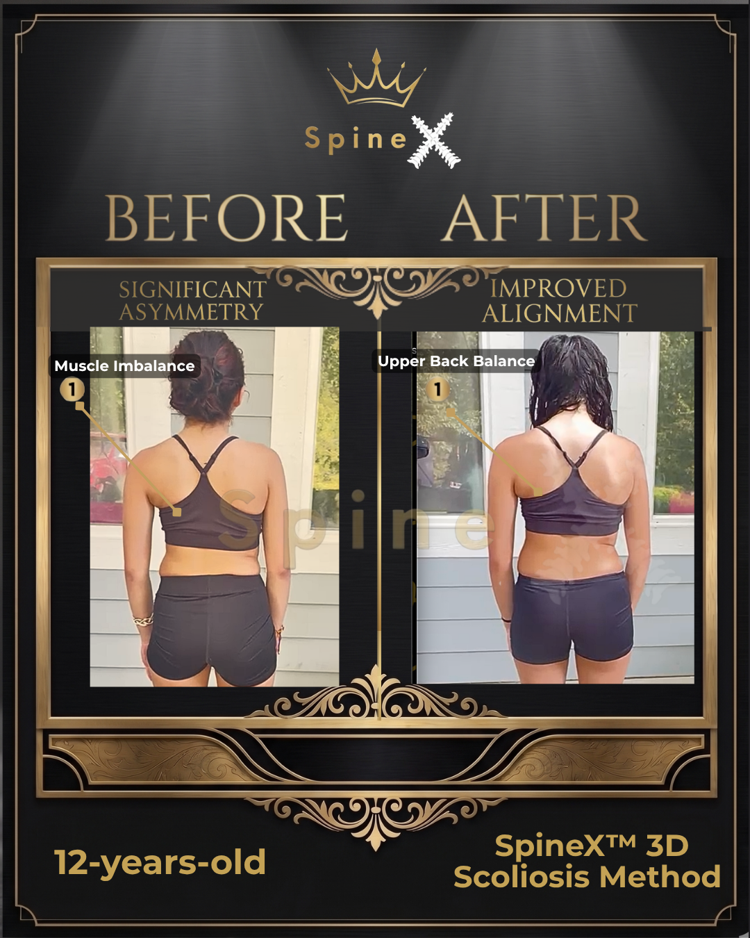 Online Scoliosis Transformation with 12-year old