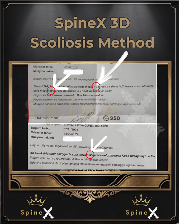 Radiology Proof of Previous Cobb Angle Reduction transformation