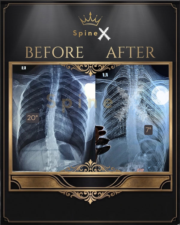 Online Scoliosis Transformation X-ray Result transformation
