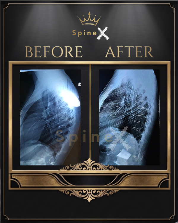 Online Kyphosis Transformation X-ray Result transformation