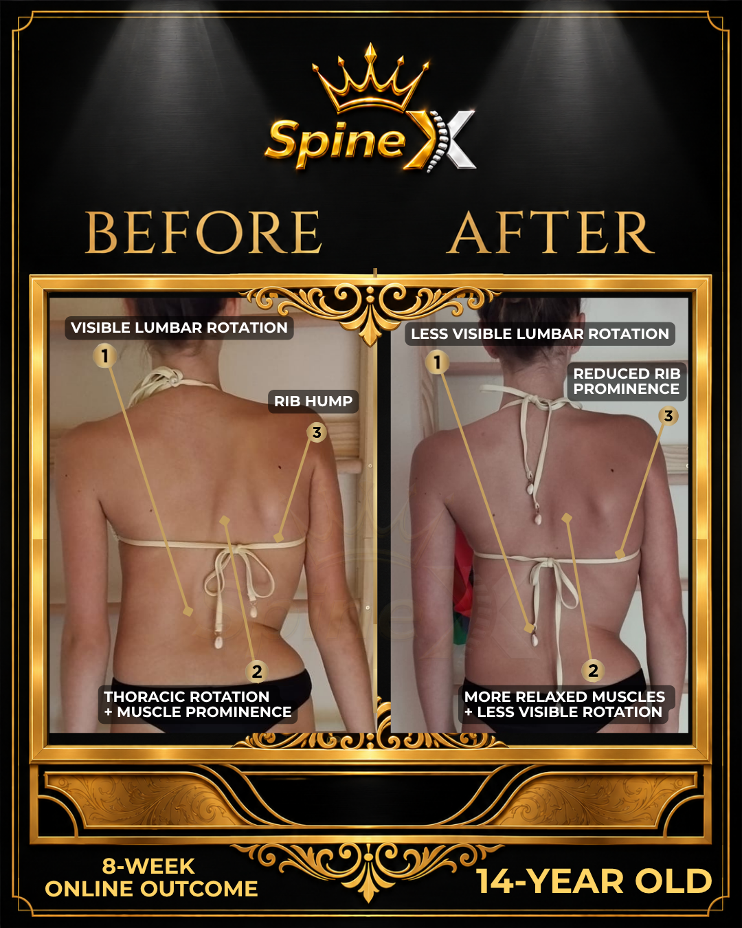 Online Scoliosis Transformation with 14-year old
