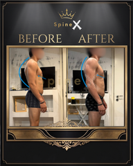 SpineX™ Kyphosis Correction Method