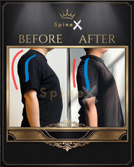 SpineX™ Kyphosis Correction Method