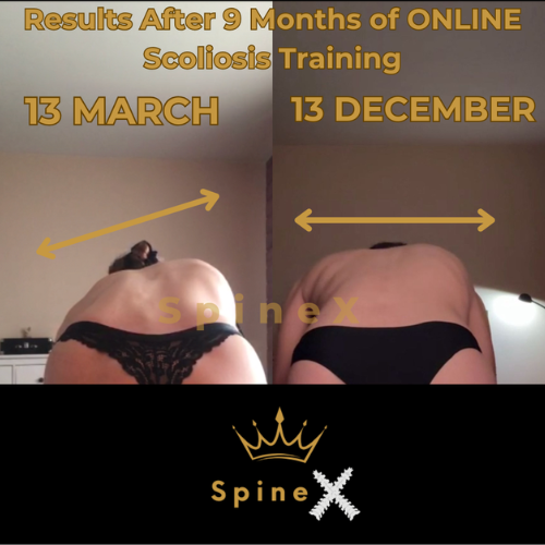3-Session Scoliosis Correction Plan (Personalized & Spine-Safe)