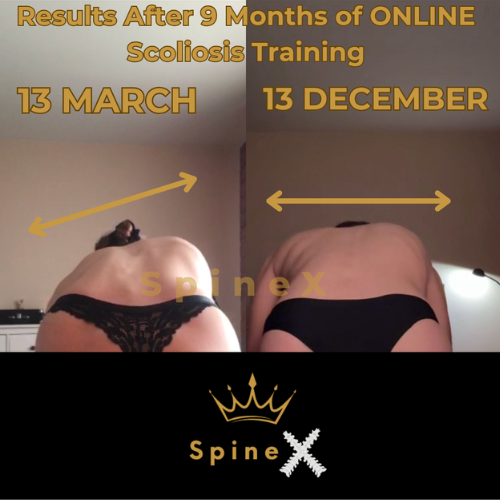 Scoliosis before and after results showing improved posture, reduced imbalance, and spinal alignment after 9 months of SpineX 3D method