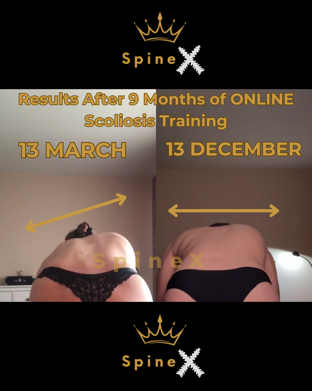before and after scoliosis transformation after 9 months online training showing improved back symmetry posture correction and spinal alignment