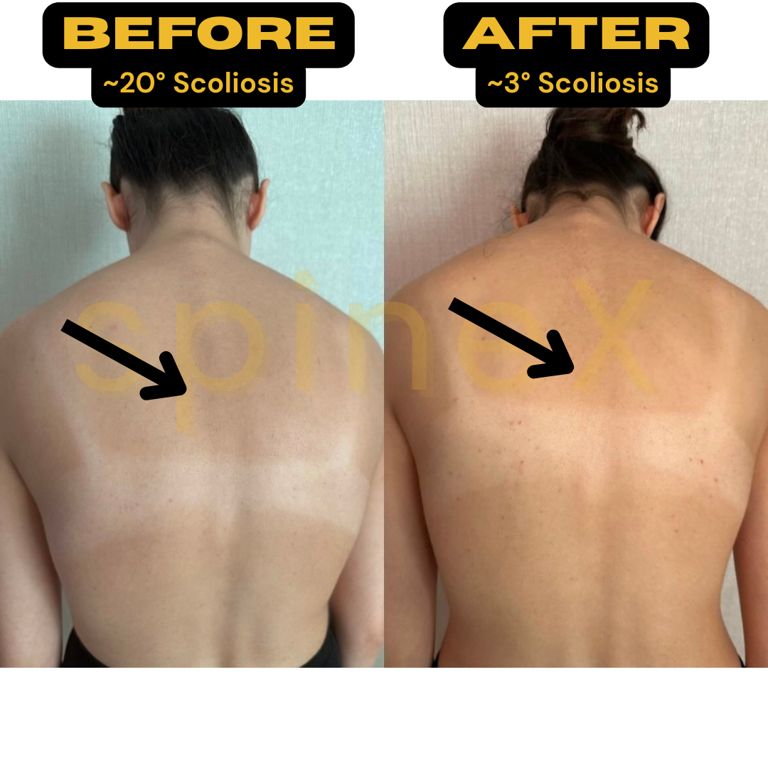before and after scoliosis back transformation showing reduced asymmetry improved posture and spinal alignment from 20 to 3 degrees