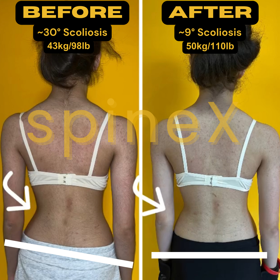 before and after scoliosis back transformation showing improved spinal symmetry waist alignment and posture reduced from 30 to 9 degrees