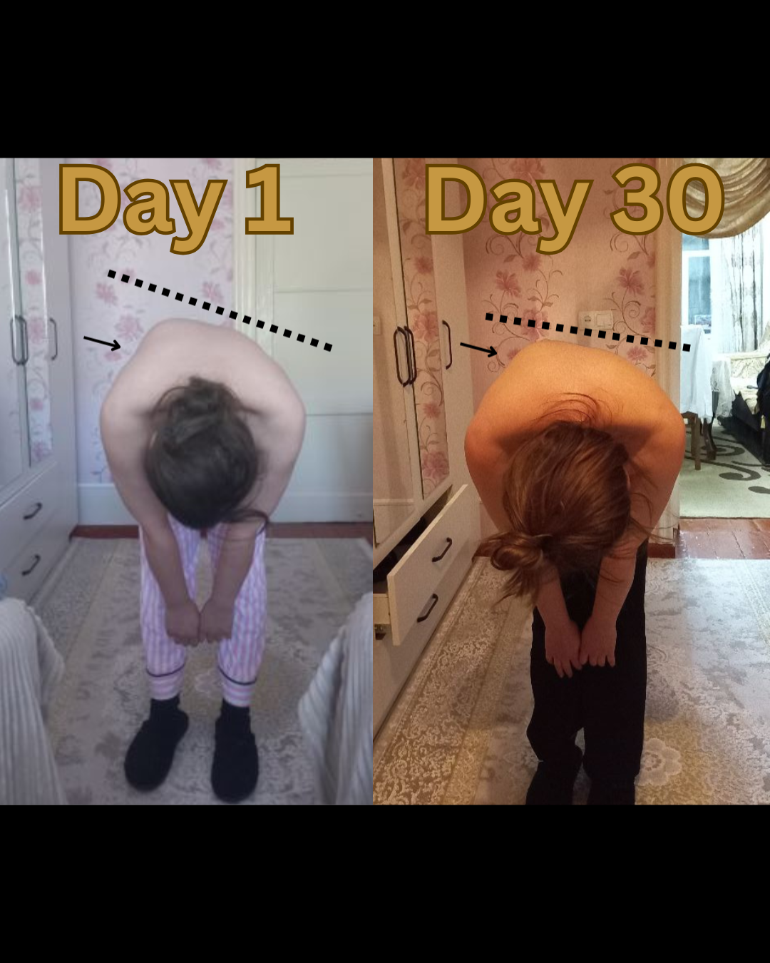 before and after scoliosis forward bend test day 1 to day 30 showing reduced rib hump improved spinal alignment and decreased back asymmetry