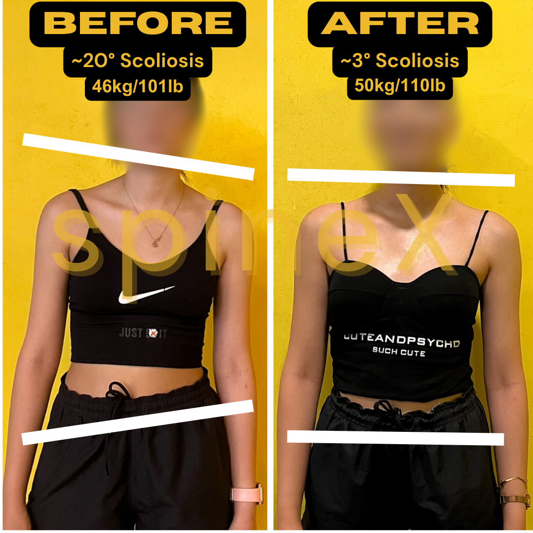 before and after scoliosis posture transformation showing improved shoulder and hip alignment reduced from 20 to 3 degrees with better body symmetry