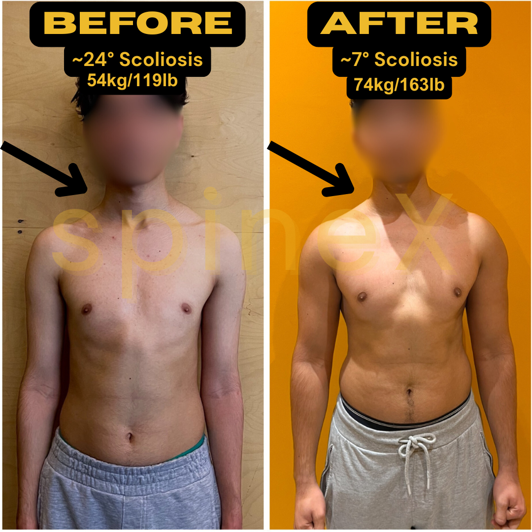 before and after scoliosis body transformation showing improved posture shoulder alignment and muscle balance reduced from 24 to 7 degrees