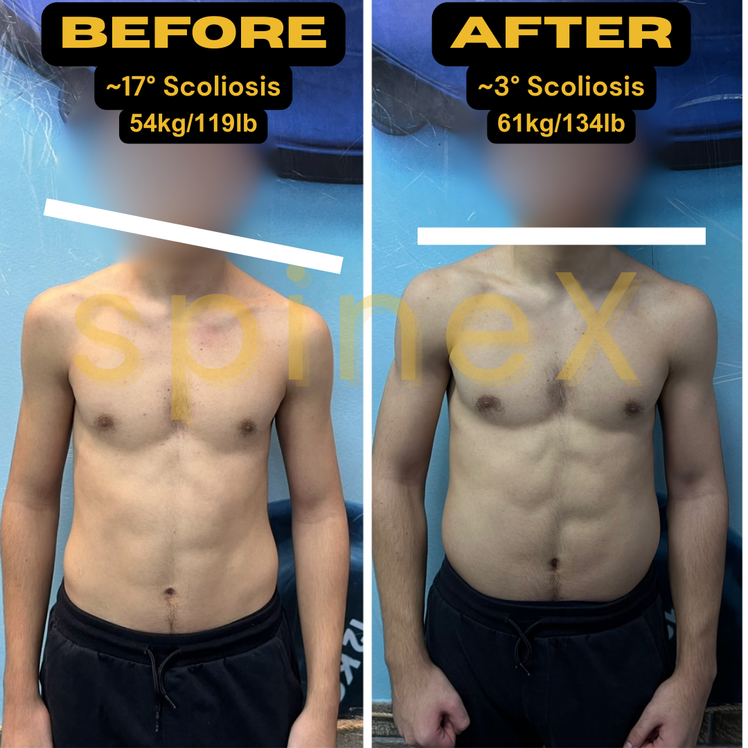 before and after scoliosis body transformation showing posture correction reduced from 17 to 3 degrees with improved muscle symmetry and alignment