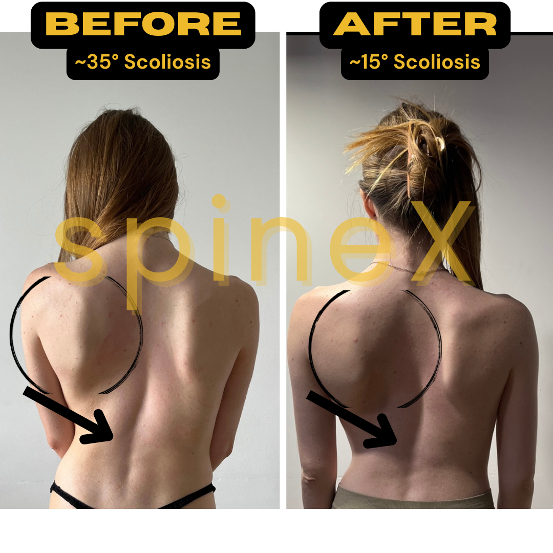 before and after scoliosis transformation showing reduced spinal rotation rib hump improvement and posture correction from 35 to 15 degrees