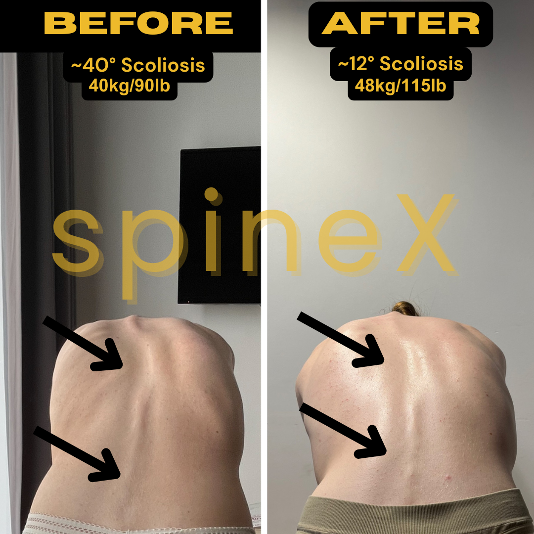 before and after severe scoliosis transformation showing curve reduction from 40 to 12 degrees with improved posture and spinal alignment
