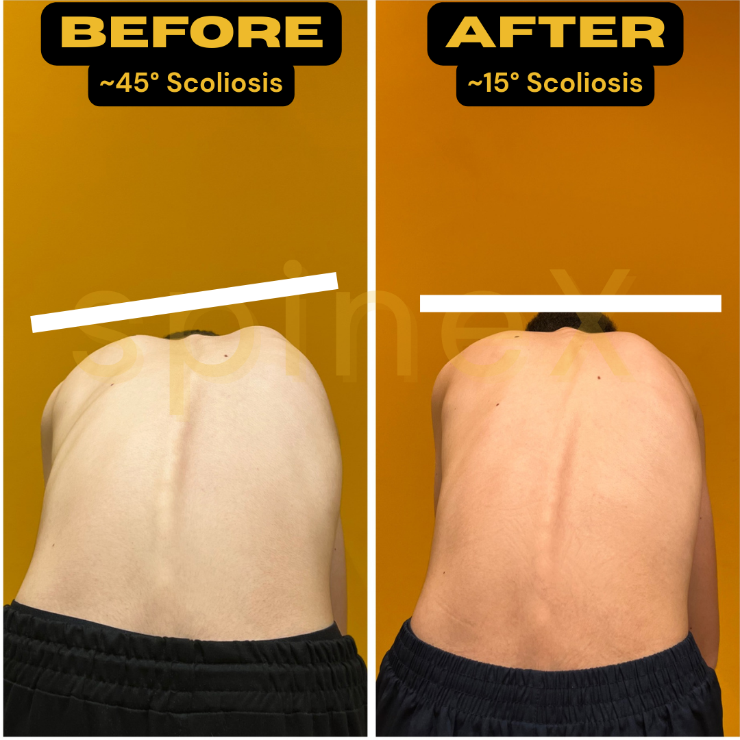 before and after severe scoliosis posture transformation showing curve reduction from 45 to 15 degrees with improved spinal alignment and symmetry