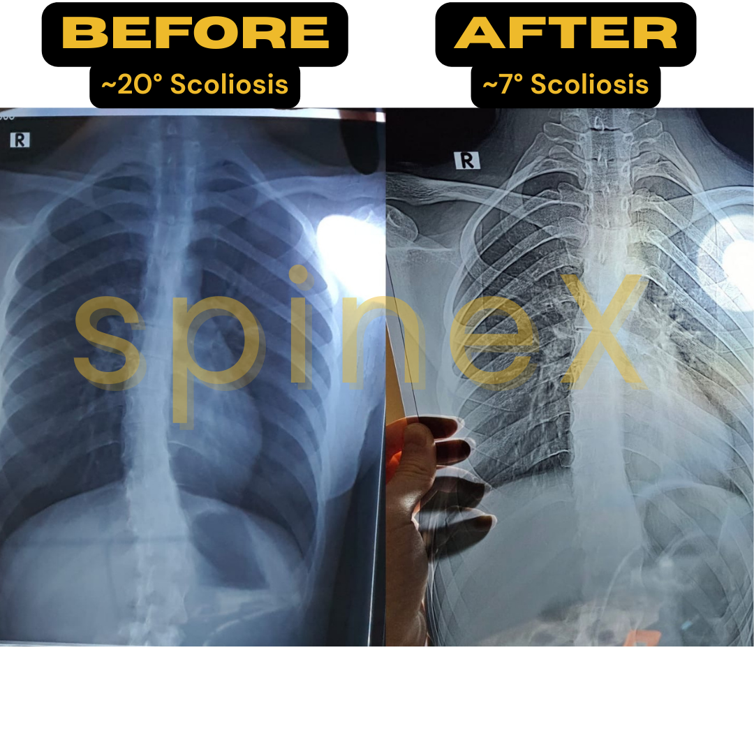 scoliosis x-ray before after showing 20 to 7 degree curvature reduction and improved spinal alignment