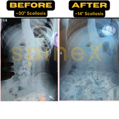 scoliosis x-ray before after showing reduced spinal curvature and improved alignment from 3D scoliosis training