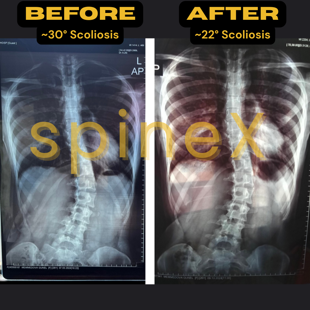 scoliosis x-ray before after with radiologist confirmed curvature reduction from 30 to 22 degrees and improved spinal alignment