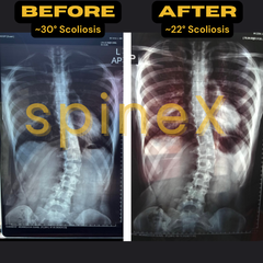 scoliosis x-ray before after with radiologist confirmed curvature reduction from 30 to 22 degrees and improved spinal alignment