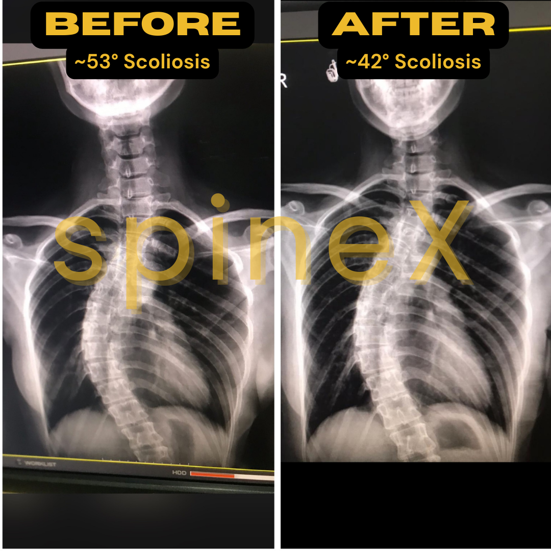 scoliosis x-ray before after with radiologist confirmed reduction from 53 to 42 degrees showing improved spinal alignment and asymmetry